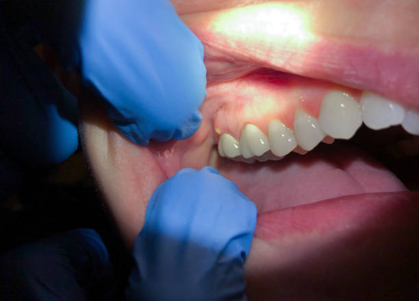 Best Broken or Chipped Tooth Repair in Urbana, MD